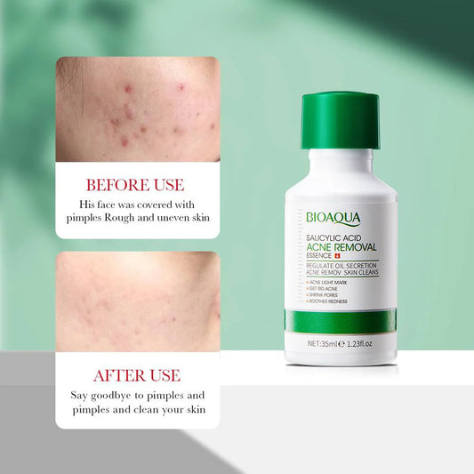 BIOAQUA Salicylic Acid Acne Removal Essence Serum 35ml – Oil Control, Pore Tightening, Anti-Acne Treatment for All Skin Types